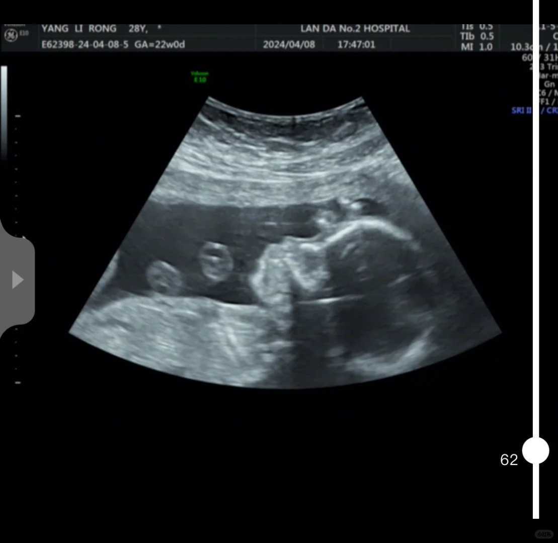 高龄女性做供卵试管婴儿费用多少费用因人而异